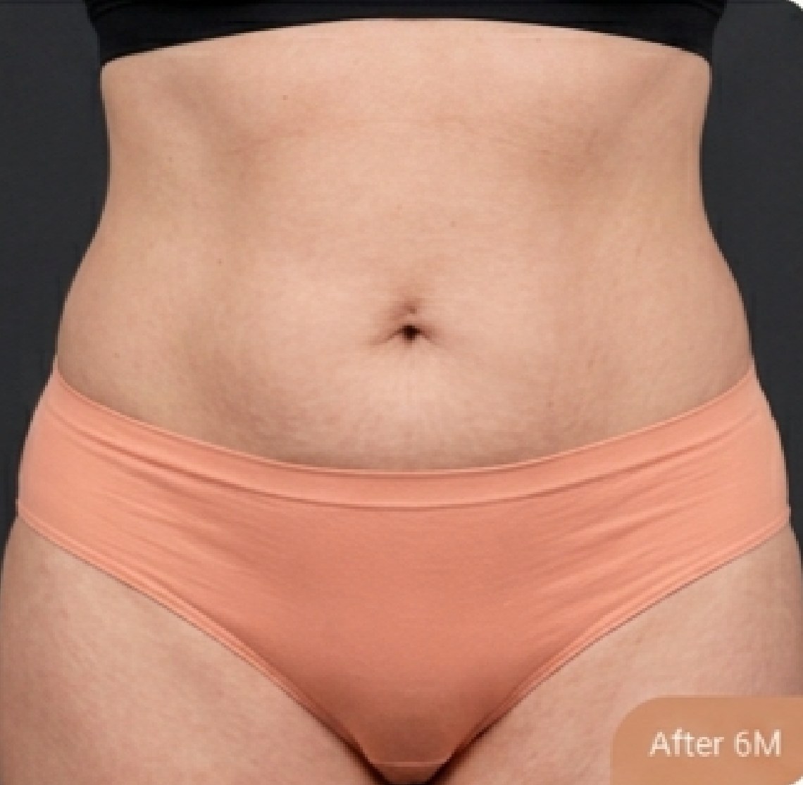 Tummy tuck (abdominoplasty) — after (Front view · 6 months post-op)