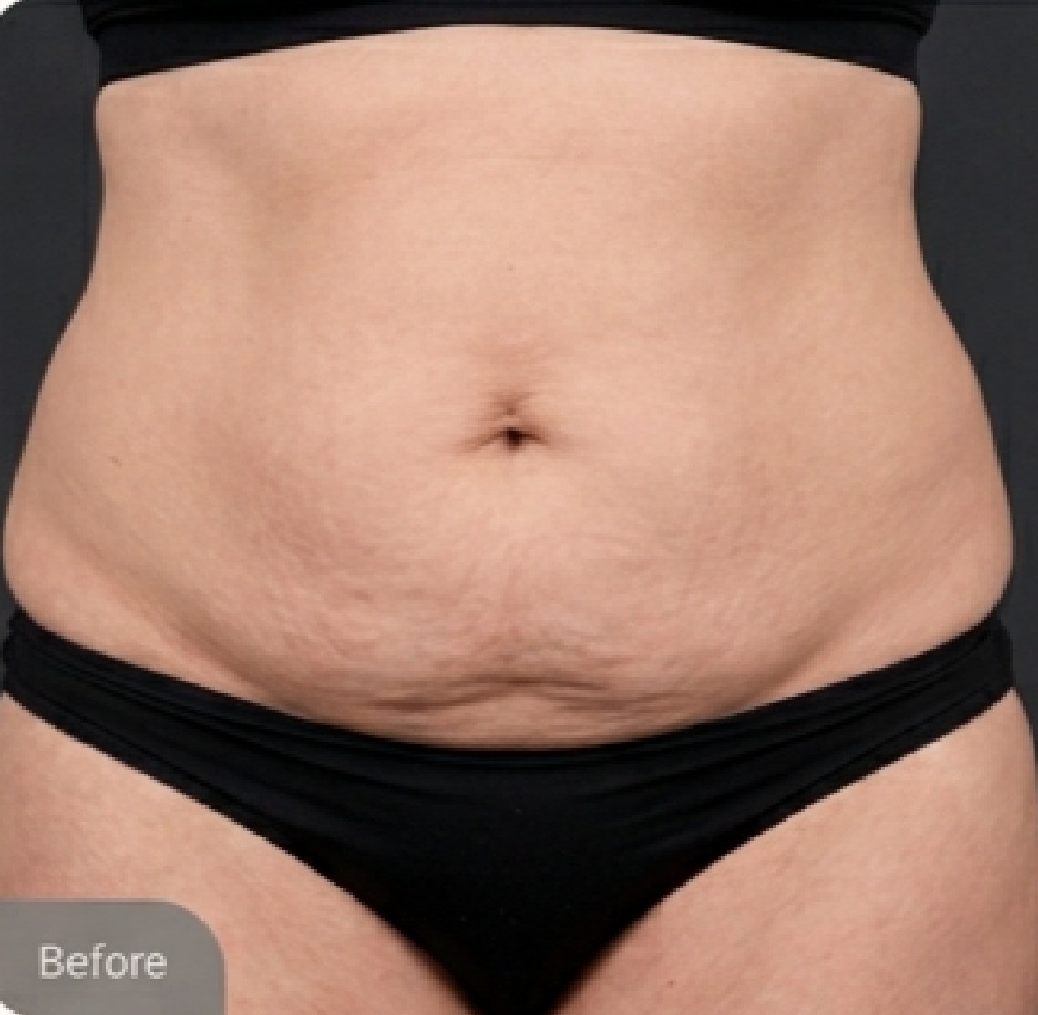 Tummy tuck (abdominoplasty) — before (Front view · 6 months post-op)