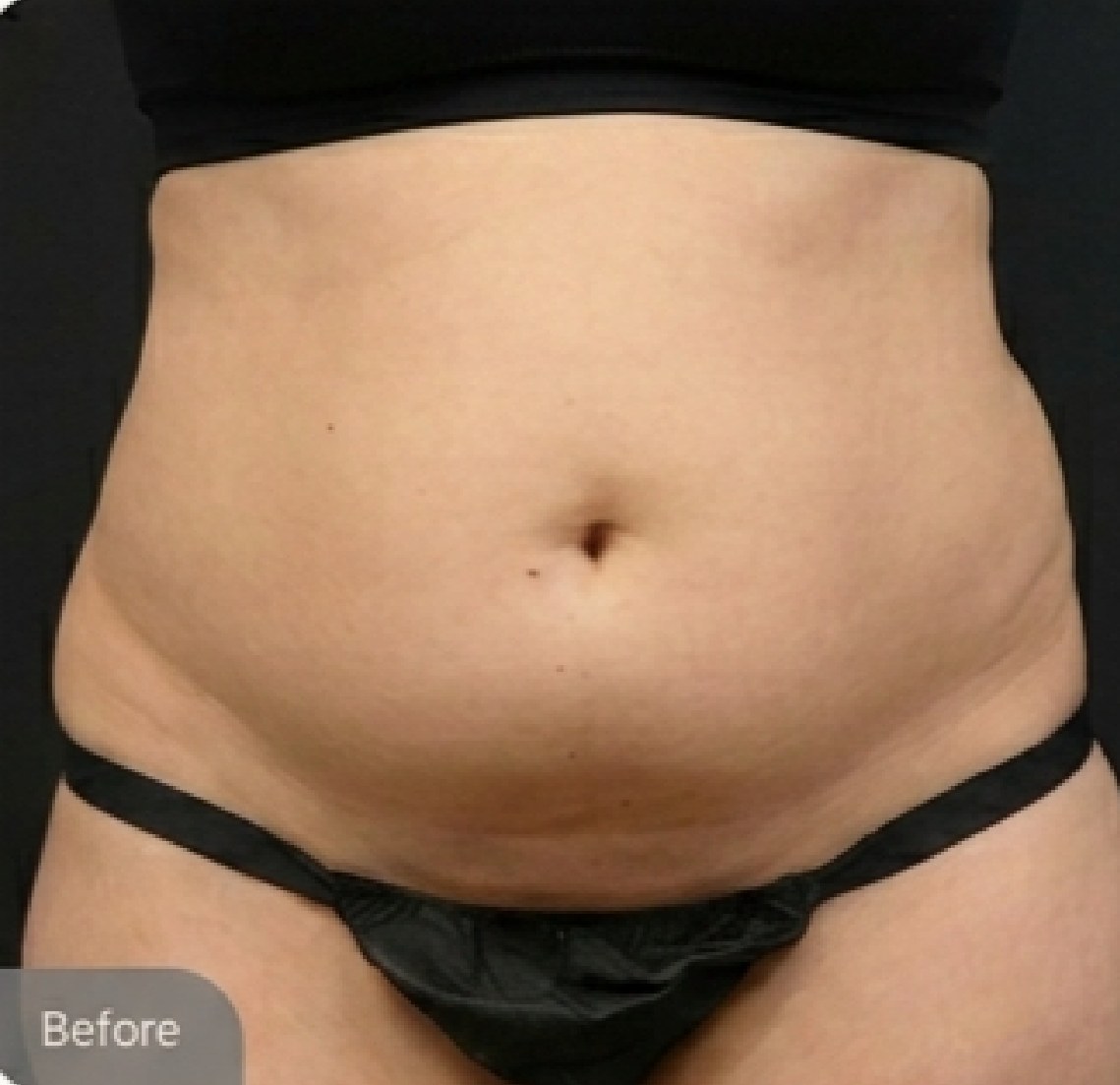 Tummy tuck (abdominoplasty) — before (Front view · 6 months post-op)