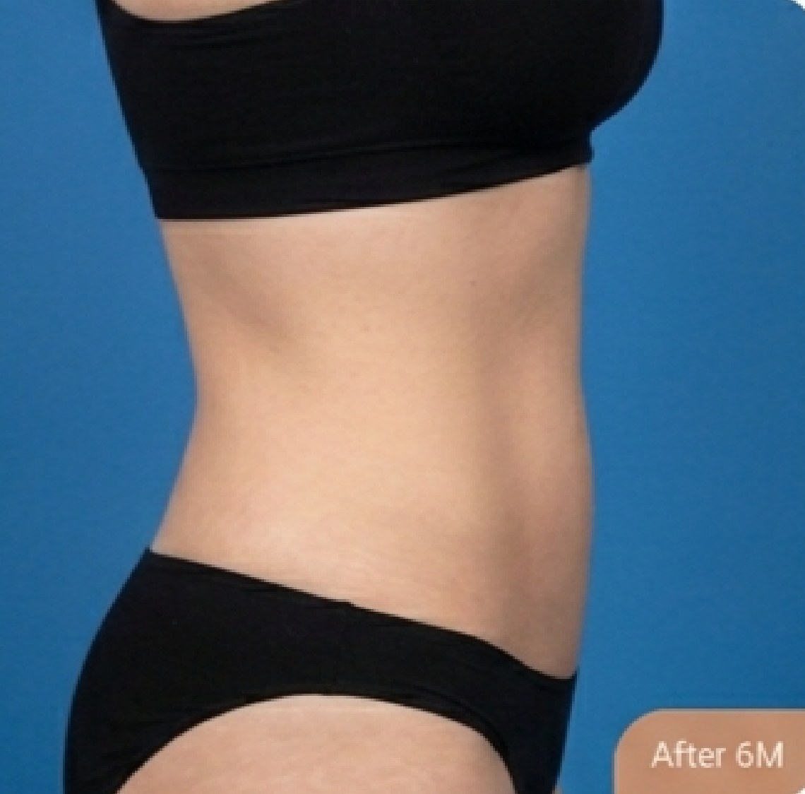 Tummy tuck (abdominoplasty) — after (Side view · 6 months post-op)