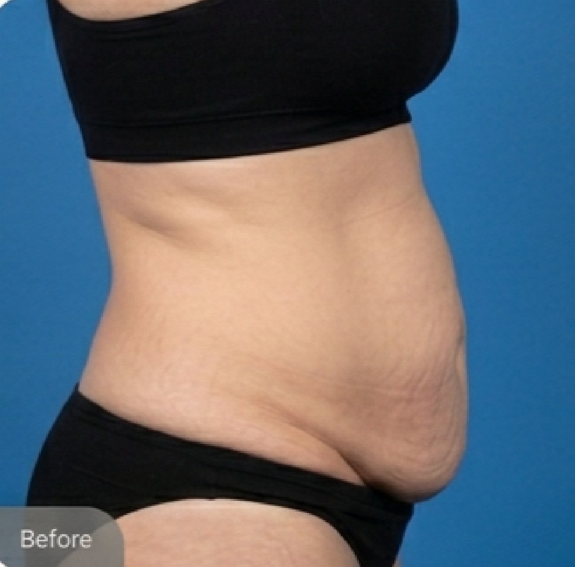 Tummy tuck (abdominoplasty) — before (Side view · 6 months post-op)