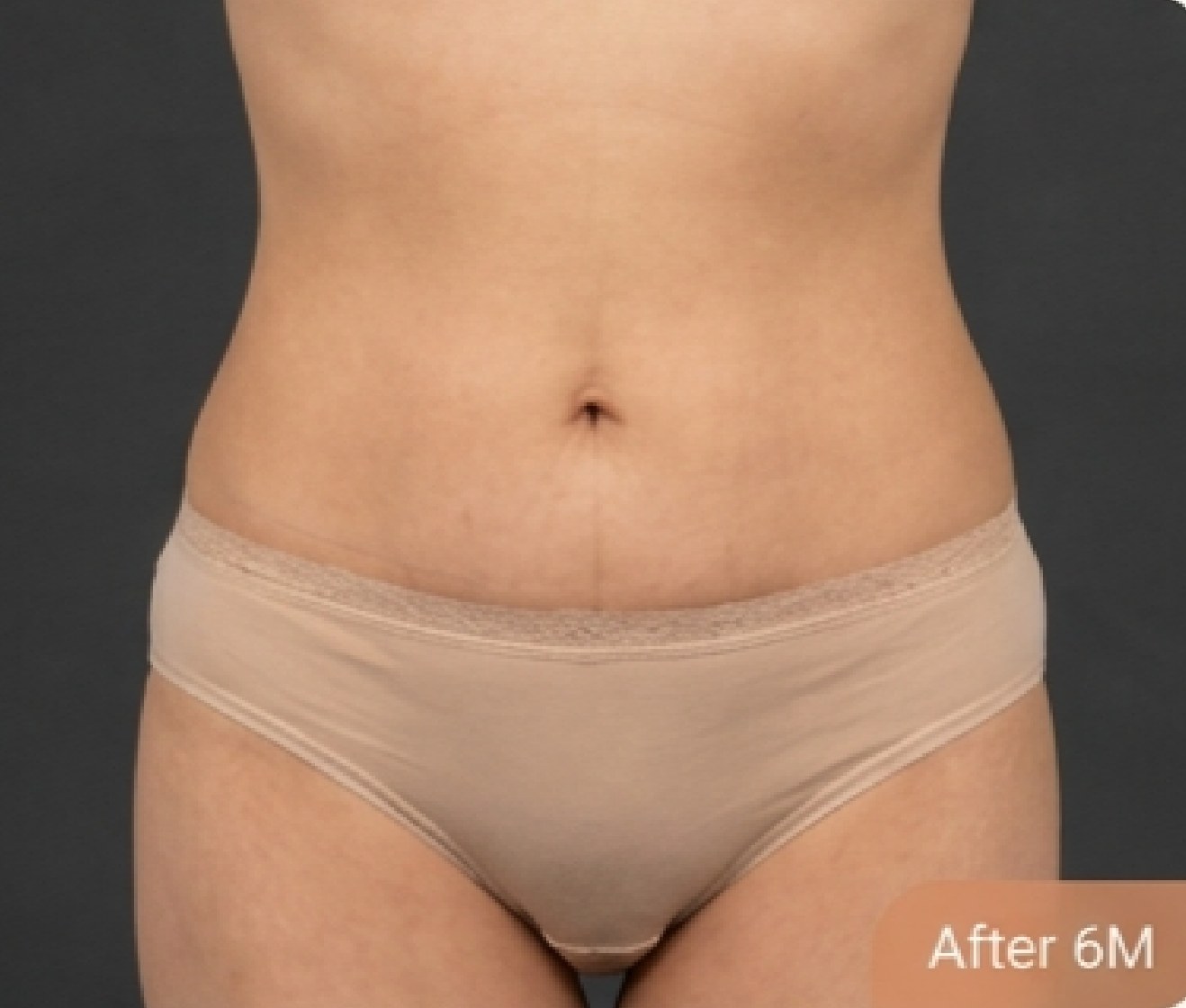 Tummy tuck (abdominoplasty) — after (Front view · 6 months post-op)