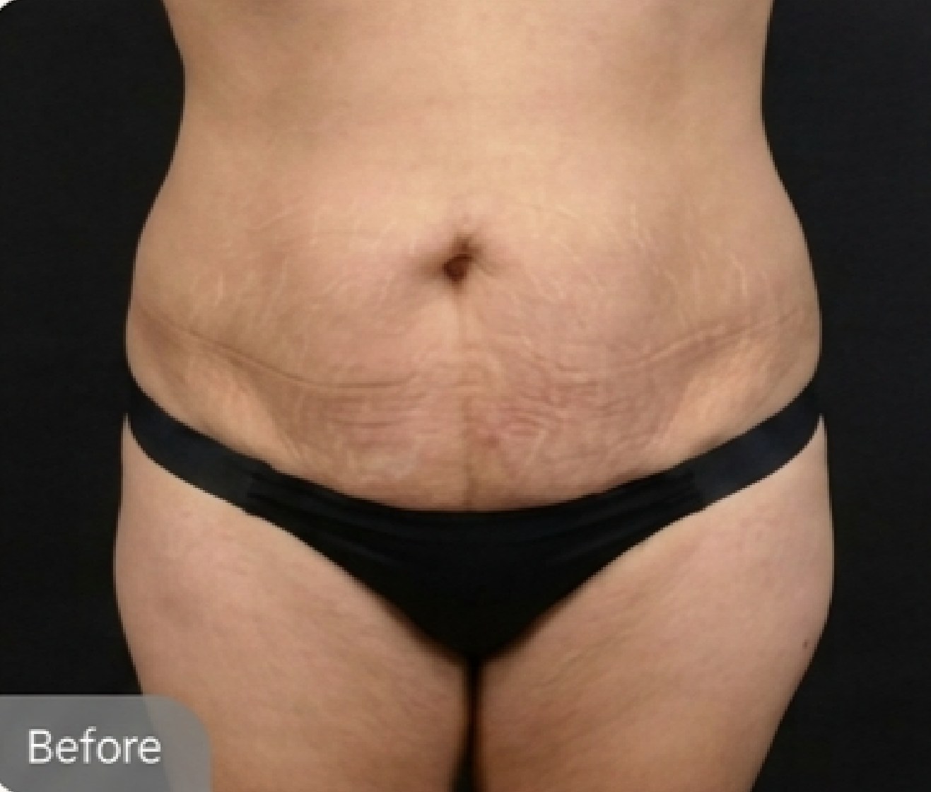 Tummy tuck (abdominoplasty) — before (Front view · 6 months post-op)